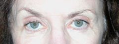 Revision Blepharoplasty - Patient 2 - Before